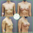 Увеличение груди анатомическими имплантами с полиуретановым покрытием 395мл