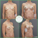 Увеличение груди анатомическими имплантами с полиуретановым покрытием 250 мл