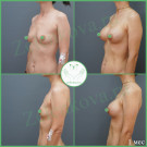 Параареолярная подтяжка груди с имплантами (анатомические 285 мл и 310 мл с полиуретановым покрытием)