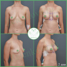 Подтяжка груди с имплантами (анатомические 270 мл с полиуретановым покрытием)