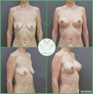 Подтяжка груди с имплантами (анатомические 405 мл с полиуретановым покрытием)