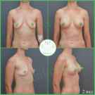Подтяжка груди с имплантами (анатомические 270 мл с полиуретановым покрытием)