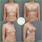 Параареолярная подтяжка груди с имплантами (анатомические 360 мл с полиуретановым покрытием)