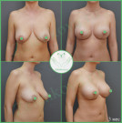 Подтяжка груди с имплантами (анатомические 405 мл с полиуретановым покрытием)