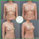 Параареолярная подтяжка груди с имплантами (анатомические 360 мл с полиуретановым покрытием)