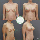 Подтяжка груди с имплантами (анатомические 360 мл с полиуретановым покрытием)