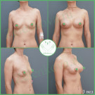 Параареолярная подтяжка груди с имплантами (анатомические 285 мл и 310 мл с полиуретановым покрытием)