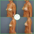 Подтяжка груди с имплантами (анатомические 310 мл с полиуретановым покрытием)