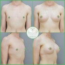 Увеличение груди из "0", анатомические импланты, параареолярный доступ