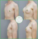 Увеличение груди из "0", анатомические импланты, параареолярный доступ