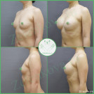 Увеличение груди анатомическими имплантами с полиуретановым покрытием 360 мл