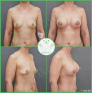 Увеличение груди анатомическими имплантами с полиуретановым покрытием 345 мл
