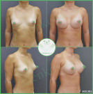 Увеличение груди анатомическими имплантами с полиуретановым покрытием 360 мл