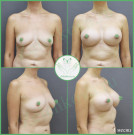 Увеличение груди анатомическими имплантами с полиуретановым покрытием 405 мл