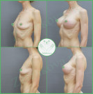 Увеличение груди анатомическими имплантами с полиуретановым покрытием 310 мл