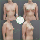 Увеличение груди с коррекцией тубулярной деформацией анатомическими имплантами с полиуретановым покрытием 285 мл