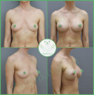 Увеличение груди анатомическими имплантами с полиуретановым покрытием 285 мл