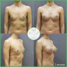 Увеличение груди анатомическими имплантами с полиуретановым покрытием 345 мл