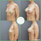 Увеличение груди анатомическими имплантами с полиуретановым покрытием 440 мл