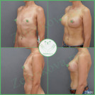 Увеличение груди анатомическими имплантами с полиуретановым покрытием 365 мл