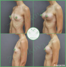 Увеличение груди анатомическими имплантами с полиуретановым покрытием 285 мл и 310 мл