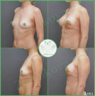 Увеличение груди анатомическими имплантами с полиуретановым покрытием 285 мл и 310 мл