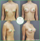 Увеличение груди анатомическими имплантами с полиуретановым покрытием 395 мл