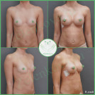 Увеличение груди анатомическими имплантами с полиуретановым покрытием 250 мл