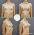 Увеличение груди анатомическими имплантами с полиуретановым покрытием 405 мл