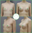 Увеличение груди круглые импланты средний профиль 335 мл