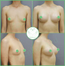 Увеличение груди. Импланты Silimed анатомические  высокий профиль с полиуретановым покрытием 310 мл