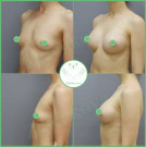 Увеличение груди. Импланты Silimed анатомические высокий профиль с полиуретановым покрытием 310 мл
