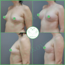 Увеличение груди импланты Polytech (Германия) анатомические высокий профиль с полиуретановым покрытием 420 мл