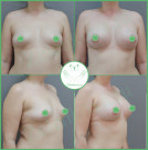 Увеличение груди импланты Polytech (Германия) анатомические высокий профиль с полиуретановым покрытием 420 мл