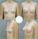 Увеличение груди. Импланты Silimed анатомические средний профиль с полиуретановым покрытием 285 мл