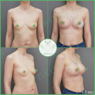 Подтяжка груди с имплантами (анатомические 310 мл и 285 мл с полиуретановым покрытием)