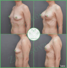 Увеличение груди анатомическими имплантами с полиуретановым покрытием 285 мл