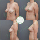 Подтяжка груди с имплантами (анатомические 365 мл с полиуретановым покрытием)