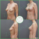 Подтяжка груди с имплантами (анатомические 365 мл с полиуретановым покрытием)