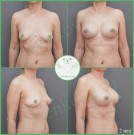 Подтяжка груди с имплантами (анатомические 285 мл с полиуретановым покрытием)