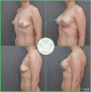 Подтяжка груди с имплантами (анатомические 285 мл с полиуретановым покрытием)