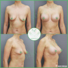 Подтяжка груди с имплантами (анатомические 360 мл с полиуретановым покрытием)