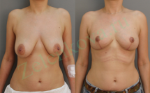 Подтяжка груди без имплантов фото до и после