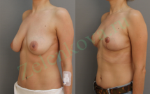 Подтяжка груди без имплантов фото до и после