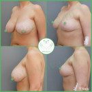 Подтяжка груди без имплантов фото до-после
